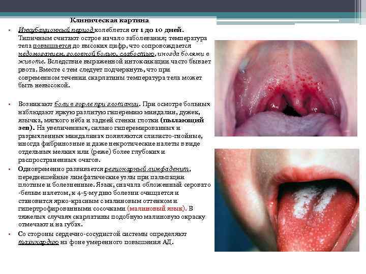  • • Клиническая картина Инкубационный период колеблется от 1 до 10 дней. Типичным