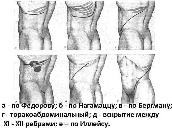 а по Федорову; б по Нагамаццу; в по Бергману; г торакоабдоминальный; д вскрытие между