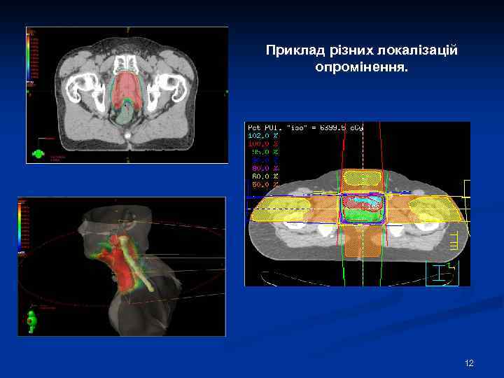 Приклад різних локалізацій опромінення. 12 
