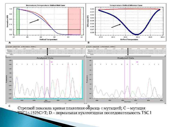 Стрелкой показана кривая плавления образца с мутацией; С – мутация TSC 1 c. 1525