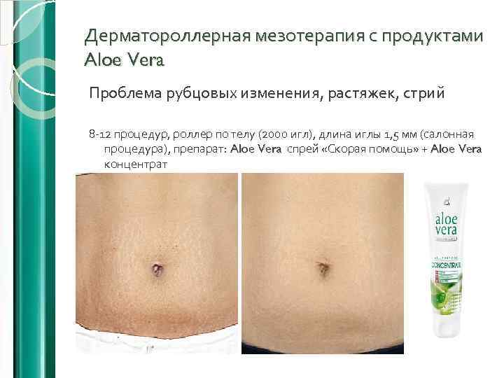 Дерматороллерная мезотерапия с продуктами Aloe Vera Проблема рубцовых изменения, растяжек, стрий 8 -12 процедур,