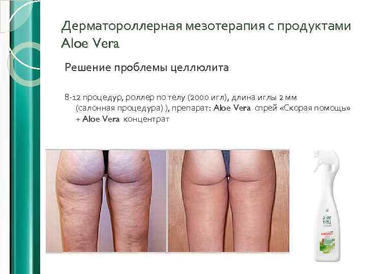 Дерматороллерная мезотерапия с продуктами Aloe Vera Решение проблемы целлюлита 8 -12 процедур, роллер по