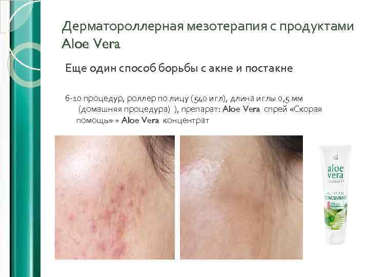 Дерматороллерная мезотерапия с продуктами Aloe Vera Еще один способ борьбы с акне и постакне