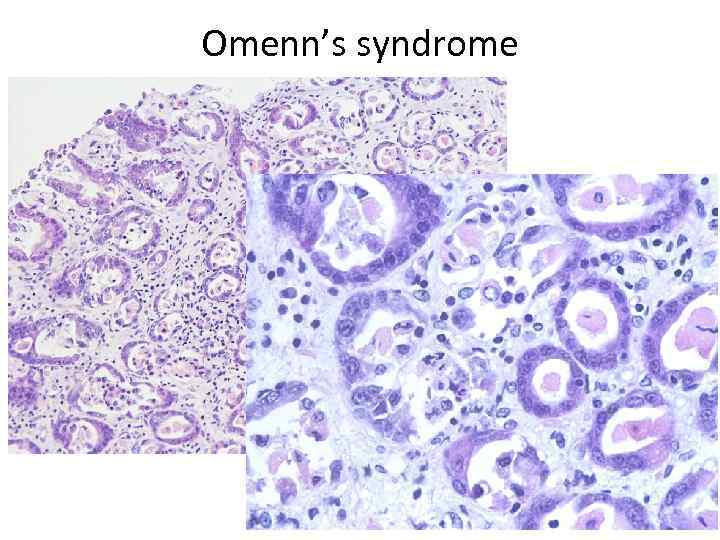 Omenn’s syndrome 