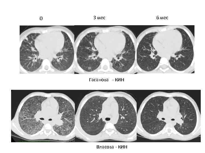 0 3 мес Гасанова - КИН Власова - КИН 6 мес 