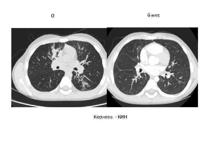 6 мес 0 Корнеев - КИН 