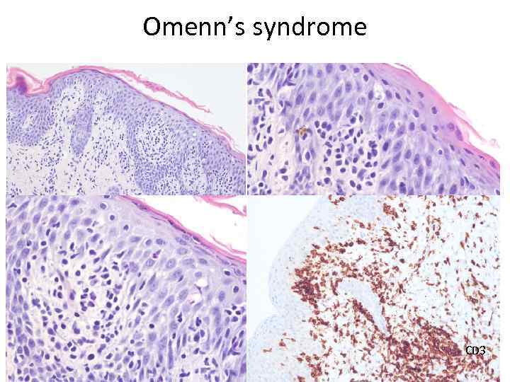 Omenn’s syndrome CD 3 