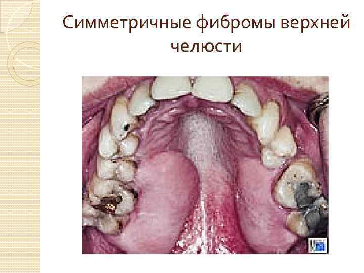 Симметричные фибромы верхней челюсти 