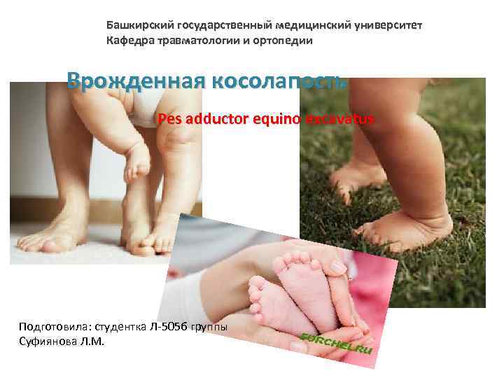 Башкирский государственный медицинский университет Кафедра травматологии и ортопедии Врожденная косолапость Pes adductor equino excavatus