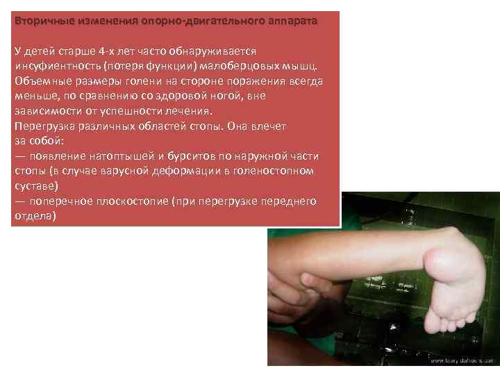 Вторичные изменения опорно-двигательного аппарата У детей старше 4 -х лет часто обнаруживается инсуфиентность (потеря