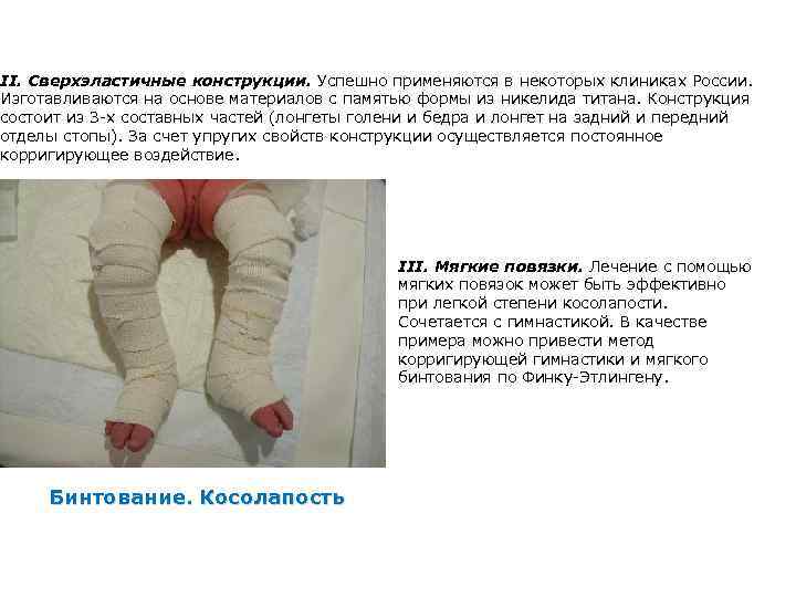 II. Сверхэластичные конструкции. Успешно применяются в некоторых клиниках России. Изготавливаются на основе материалов с