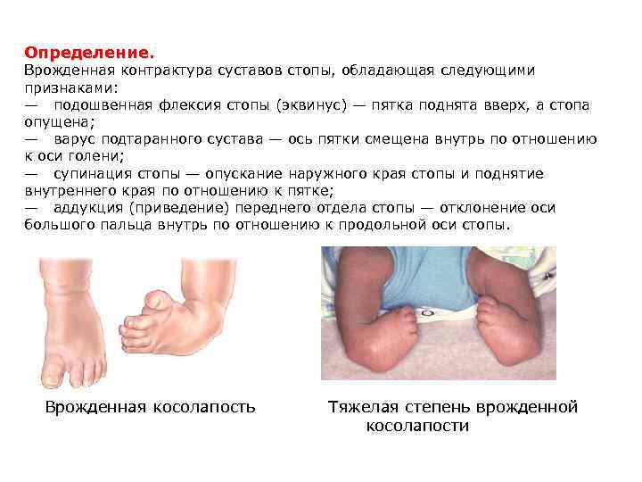Определение. Врожденная контрактура суставов стопы, обладающая следующими признаками: — подошвенная флексия стопы (эквинус) —