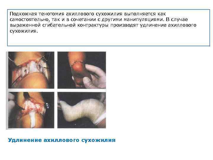 Подкожная тенотомия ахиллового сухожилия выполняется как самостоятельно, так и в сочетании с другими манипуляциями.
