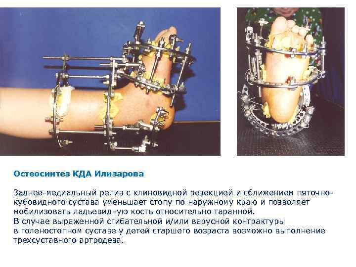 Аппарат илизарова на бедренной кости фото