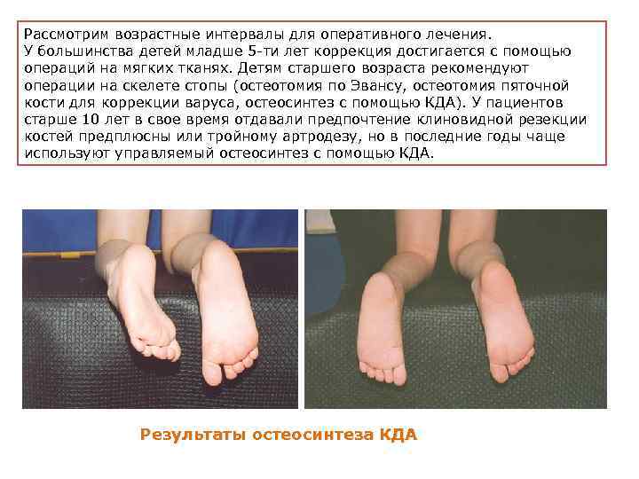Рассмотрим возрастные интервалы для оперативного лечения. У большинства детей младше 5 -ти лет коррекция