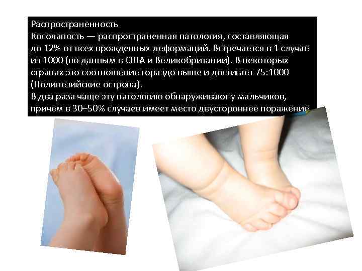 Распространенность Косолапость — распространенная патология, составляющая до 12% от всех врожденных деформаций. Встречается в