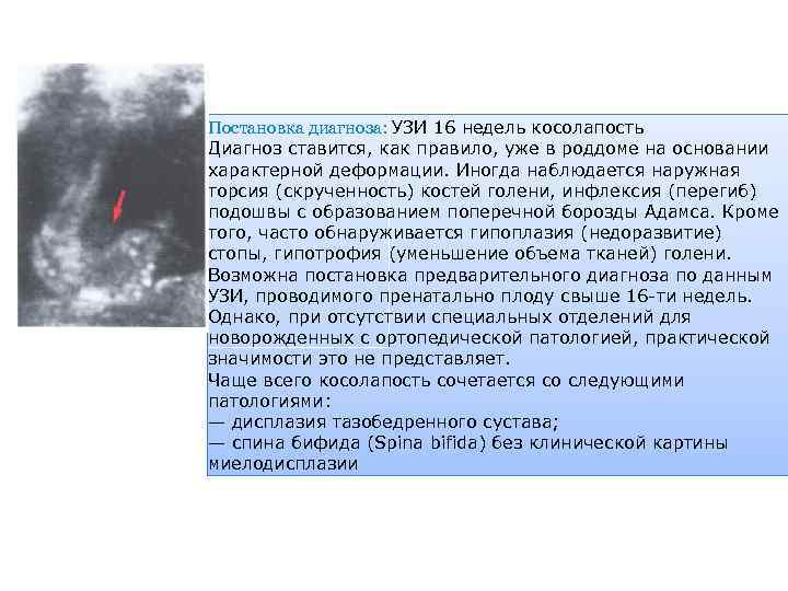 Постановка диагноза: УЗИ 16 недель косолапость Диагноз ставится, как правило, уже в роддоме на