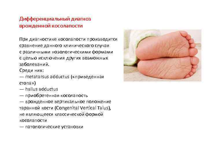 Дифференциальный диагноз врожденной косолапости При диагностике косолапости производится сравнение данного клинического случая с различными