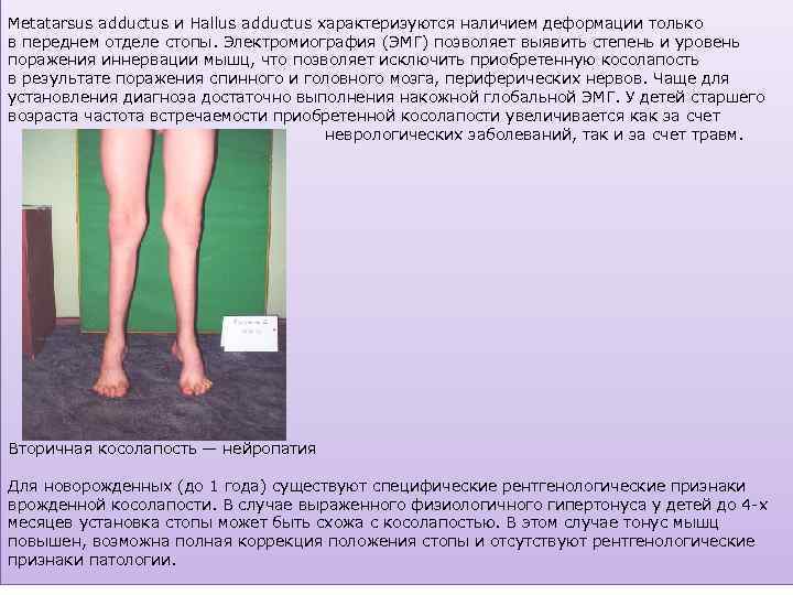 Metatarsus adductus и Hallus adductus характеризуются наличием деформации только в переднем отделе стопы. Электромиография