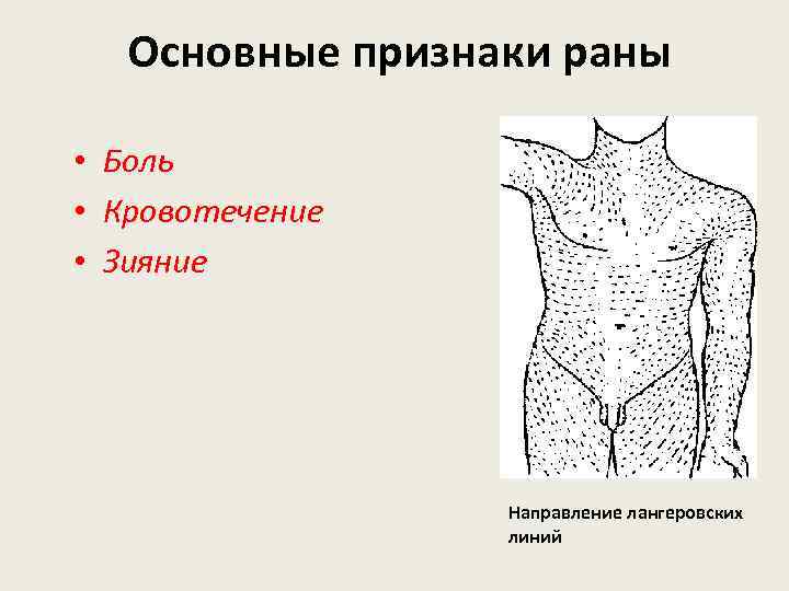 Основные признаки раны • Боль • Кровотечение • Зияние Направление лангеровских линий 