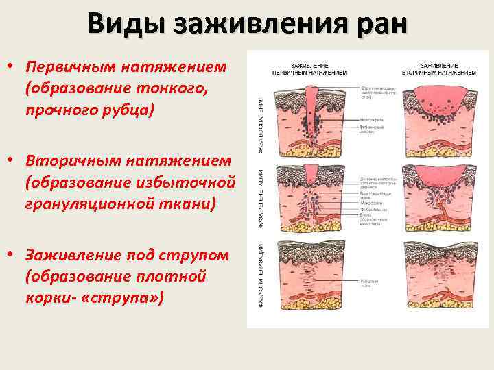 Виды заживления ран • Первичным натяжением (образование тонкого, прочного рубца) • Вторичным натяжением (образование