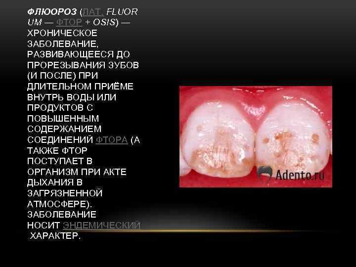 ФЛЮОРОЗ (ЛАТ. FLUOR UM — ФТОР + OSIS) — ХРОНИЧЕСКОЕ ЗАБОЛЕВАНИЕ, РАЗВИВАЮЩЕЕСЯ ДО ПРОРЕЗЫВАНИЯ