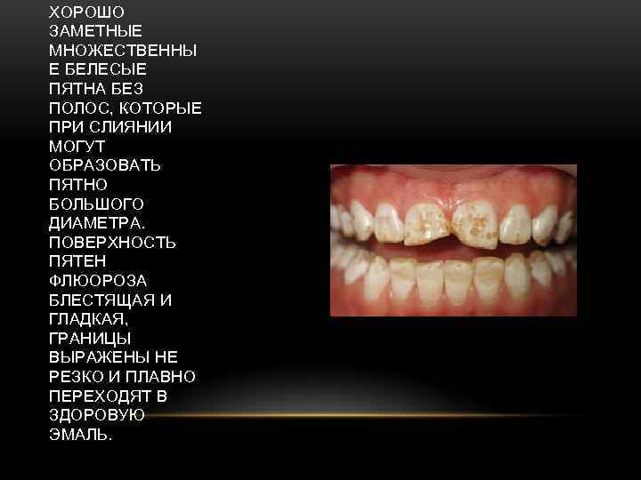 ХОРОШО ЗАМЕТНЫЕ МНОЖЕСТВЕННЫ Е БЕЛЕСЫЕ ПЯТНА БЕЗ ПОЛОС, КОТОРЫЕ ПРИ СЛИЯНИИ МОГУТ ОБРАЗОВАТЬ ПЯТНО