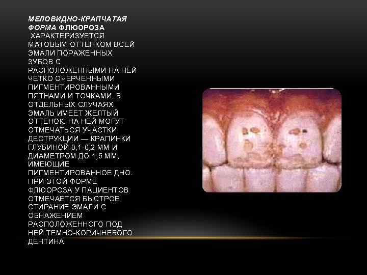 МЕЛОВИДНО-КРАПЧАТАЯ ФОРМА ФЛЮОРОЗА ХАРАКТЕРИЗУЕТСЯ МАТОВЫМ ОТТЕНКОМ ВСЕЙ ЭМАЛИ ПОРАЖЕННЫХ ЗУБОВ С РАСПОЛОЖЕННЫМИ НА НЕЙ