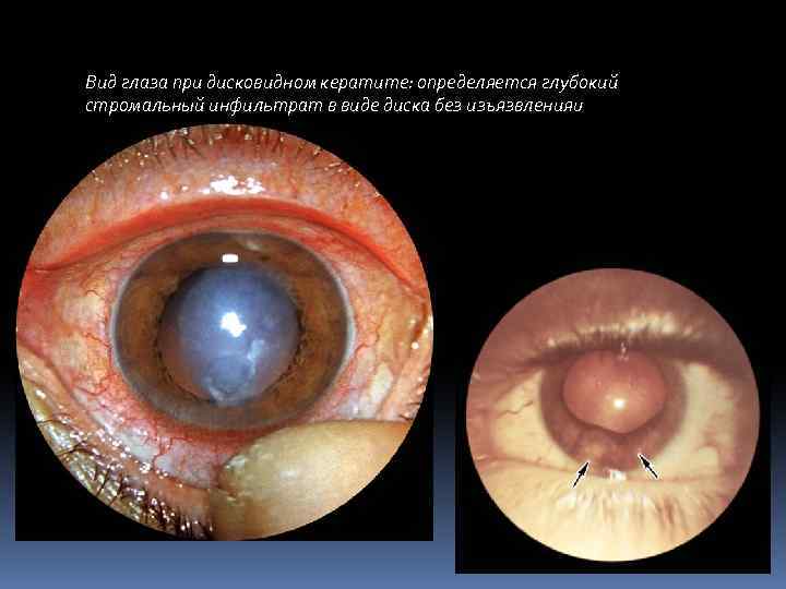 Вид глаза при дисковидном кератите: определяется глубокий стромальный инфильтрат в виде диска без изъязвленияu