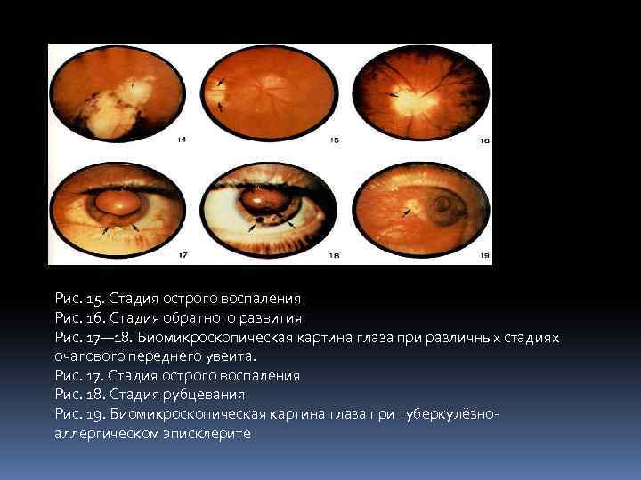 Рис. 15. Стадия острого воспаления Рис. 16. Стадия обратного развития Рис. 17— 18. Биомикроскопическая