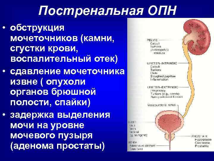 Постренальная ОПН • обструкция мочеточников (камни, сгустки крови, воспалительный отек) • сдавление мочеточника извне