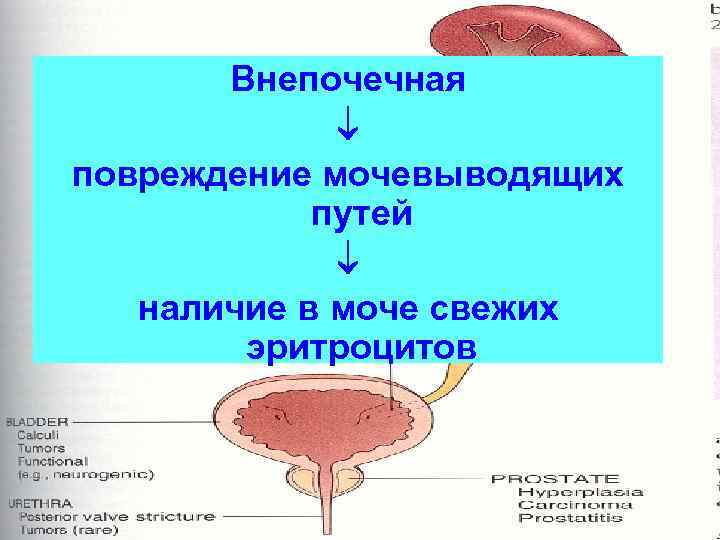 Внепочечная повреждение мочевыводящих путей наличие в моче свежих эритроцитов 