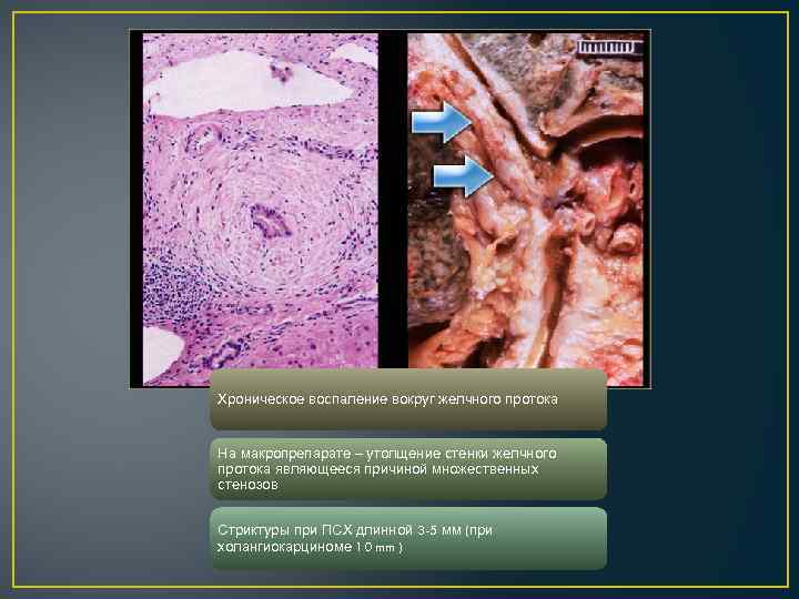 Хроническое воспаление вокруг желчного протока На макропрепарате – утолщение стенки желчного протока являющееся причиной
