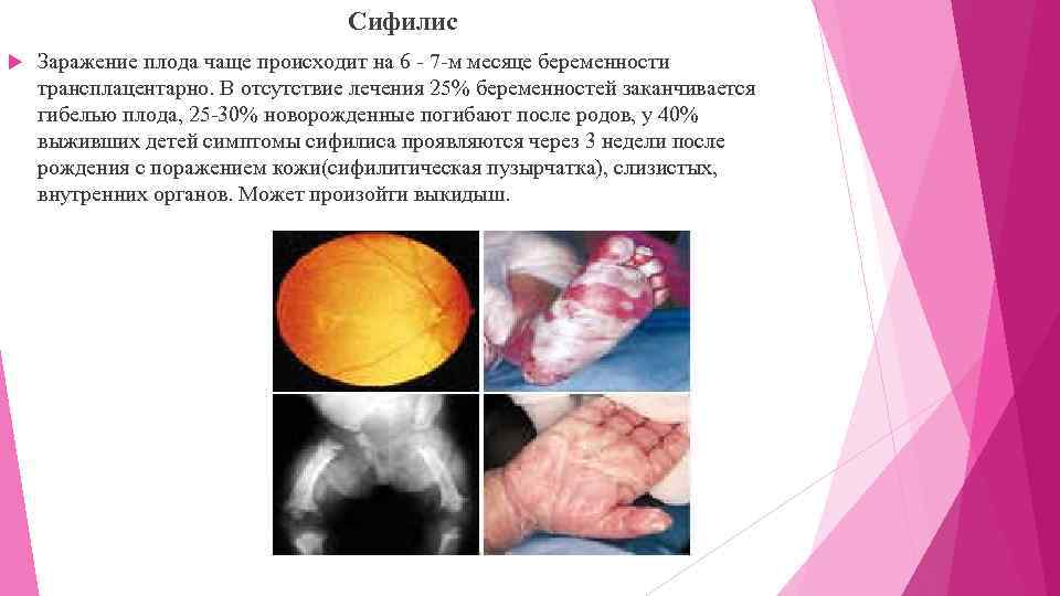 Сифилис Заражение плода чаще происходит на 6 - 7 -м месяце беременности трансплацентарно. В