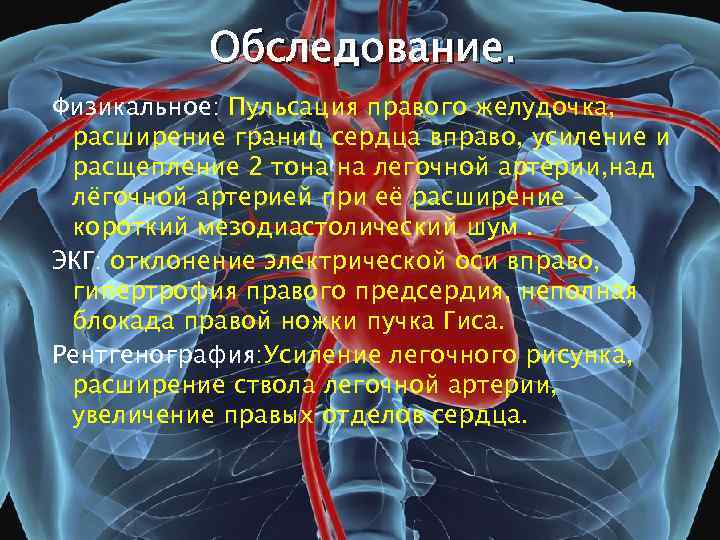 Обследование. Физикальное: Пульсация правого желудочка, расширение границ сердца вправо, усиление и расщепление 2 тона