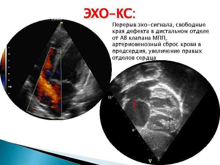ЭХО-КС: Перерыв эхо-сигнала, свободные края дефекта в дистальном отделе от АВ клапана МПП, артериовенозный