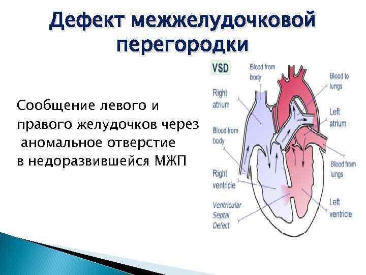 Дефект межжелудочковой перегородки Сообщение левого и правого желудочков через аномальное отверстие в недоразвившейся МЖП