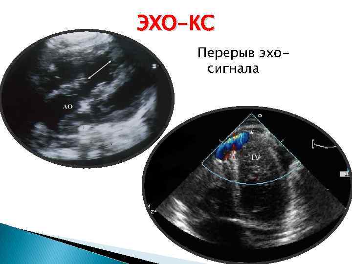 ЭХО-КС Перерыв эхосигнала 