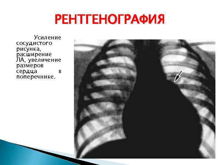 РЕНТГЕНОГРАФИЯ Усиление сосудистого рисунка, расширение ЛА, увеличение размеров сердца в поперечнике. 