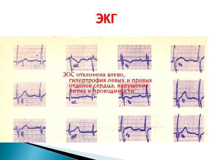 ЭКГ ЭОС отклонена влево, гипертрофия левых и правых отделов сердца, нарушение ритма и проводимости.