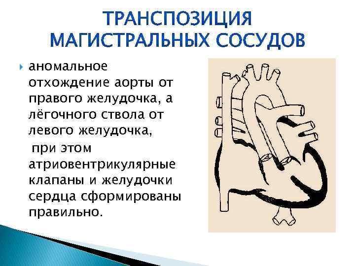  аномальное отхождение аорты от правого желудочка, а лёгочного ствола от левого желудочка, при