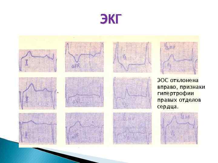 ЭКГ ЭОС отклонена вправо, признаки гипертрофии правых отделов сердца. 