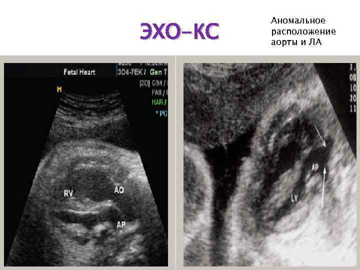 ЭХО-КС Аномальное расположение аорты и ЛА 