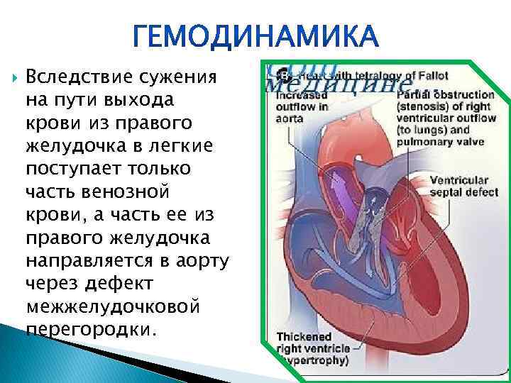 Вследствие сужения на пути выхода крови из правого желудочка в легкие поступает только