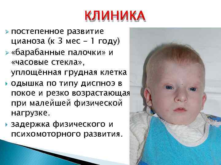 Ø постепенное КЛИНИКА развитие цианоза (к 3 мес - 1 году) Ø «барабанные палочки»