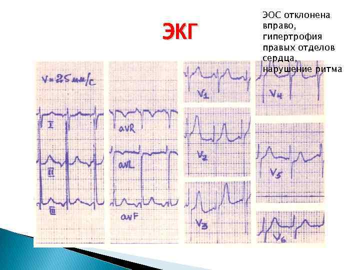 ЭКГ ЭОС отклонена вправо, гипертрофия правых отделов сердца, нарушение ритма 