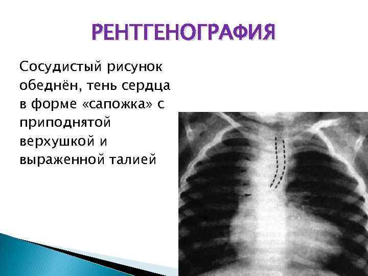 РЕНТГЕНОГРАФИЯ Сосудистый рисунок обеднён, тень сердца в форме «сапожка» с приподнятой верхушкой и выраженной