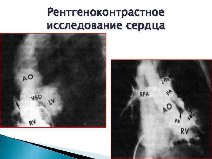 Рентгеноконтрастное исследование сердца 