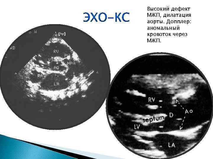 Высокий дефект МЖП, дилатация аорты. Допплер: аномальный кровоток через МЖП. 