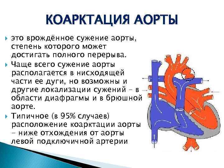 КОАРКТАЦИЯ АОРТЫ это врождённое сужение аорты, степень которого может достигать полного перерыва. Чаще всего